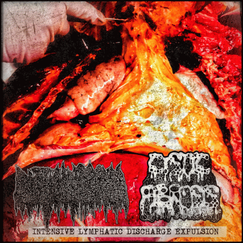 Cystic Hygroma : Intensive Lymphatic Discharge Expulsion